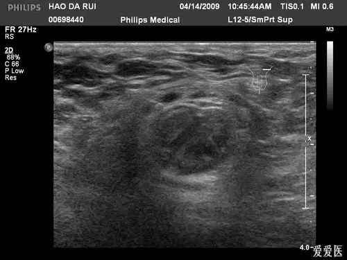 腹股沟疝 - 超声医学讨论版 - 爱爱医医学论坛