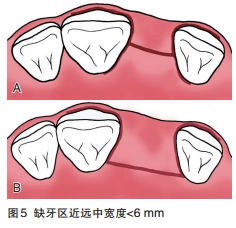 牙槽嵴顶切口(又称水平切口)