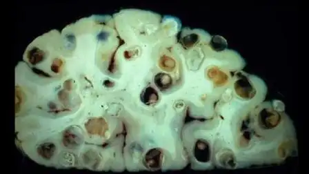 什么是脑囊虫病? 武汉科技大学附属普仁医院神经内科讲解脑囊虫病!