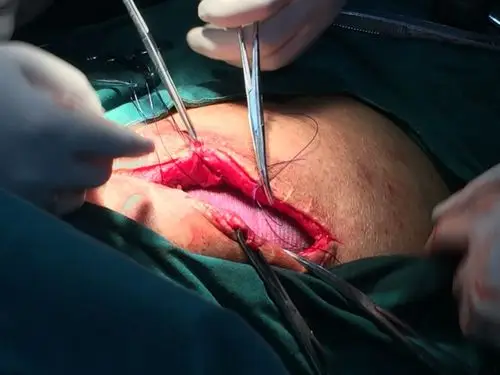 运用悬吊法固定补片,皮下同一穿刺点,不同方向穿入拉出缝线