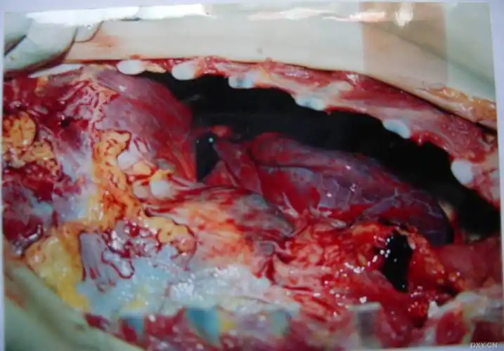 [学术讨论]死因分析