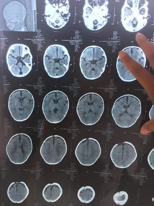 3个月的宝宝,因为不会翻身下肢支撑弱做了脑部ct.请看下左侧