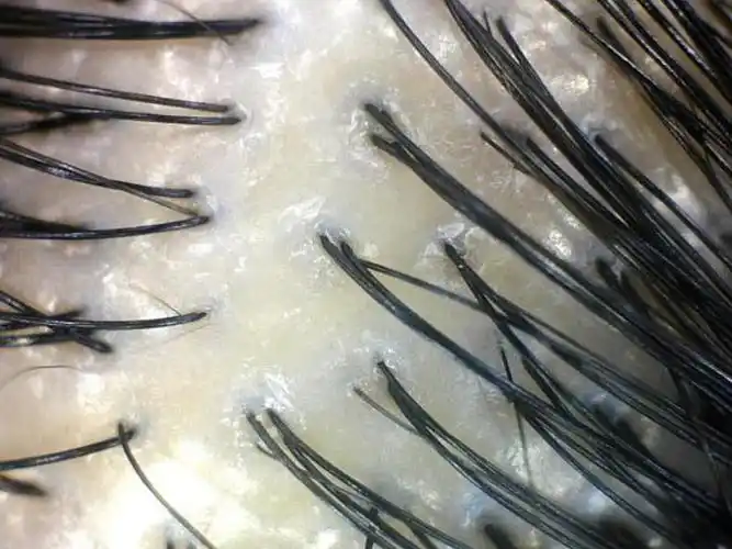 图一二为干性头皮治疗前后