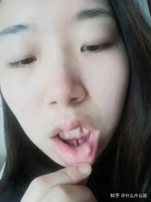 我的口腔囊肿治疗过程记录