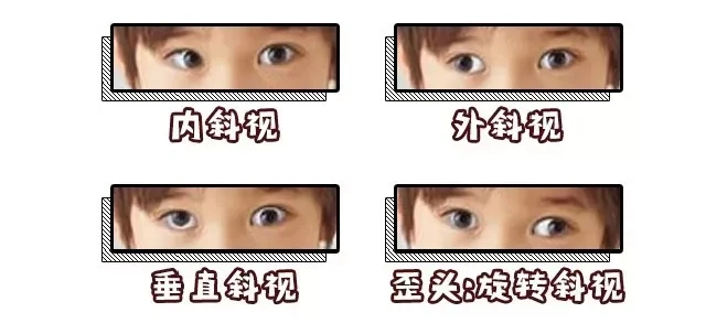 9岁男孩眼睛不"正", 以为是用眼习惯不好,原来是"生病"了|斜视|邓琪琳