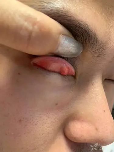 上眼睑肿物 有异物感 请教大家这是什么? [病例帖]