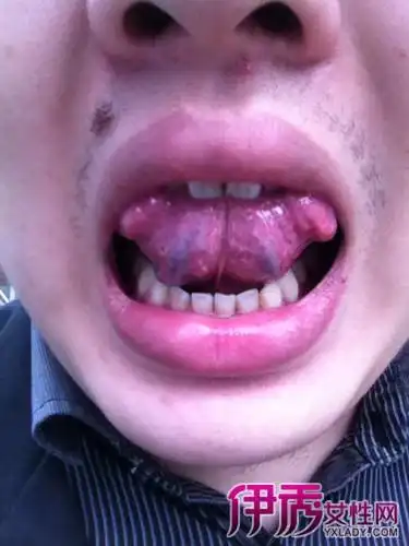 【舌头底下血管发黑图片】舌头底下血管根部粗大发紫发黑是血瘀病吗