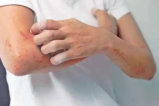 【春季,警惕这3种过敏性皮肤病】