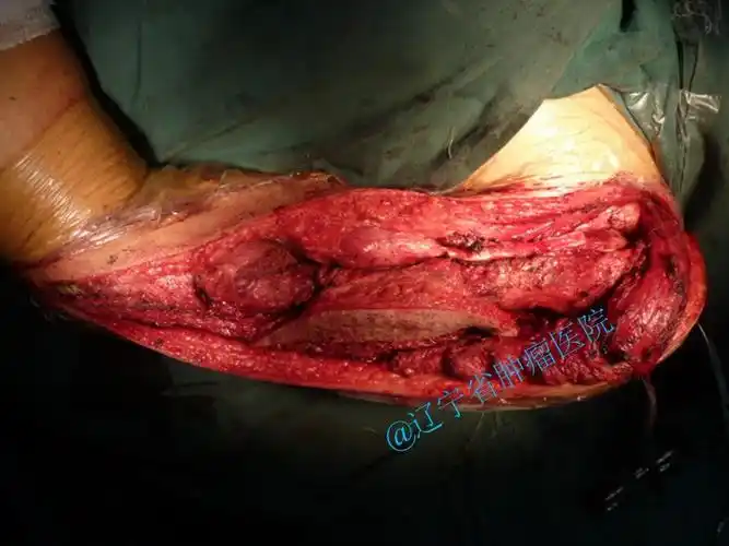 肱骨恶性肿瘤切除全肱骨假体置换术