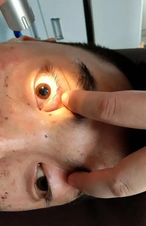 术前双瞳散大的