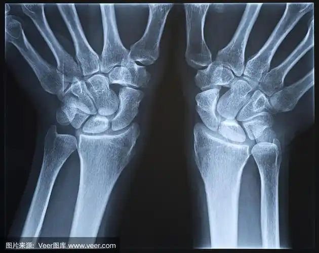 手腕x射线.女性.