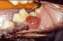 组图是牙龈瘤患者,有关此病的描述不正确的是()第3题点击查看答案上颌