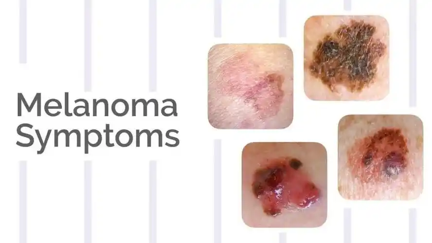 01,死亡率最高的皮肤癌:黑色素瘤