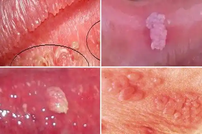 后期逐渐增多,增大,形态可以为乳头状,菜花状,鸡冠状及蕈状,颜色为