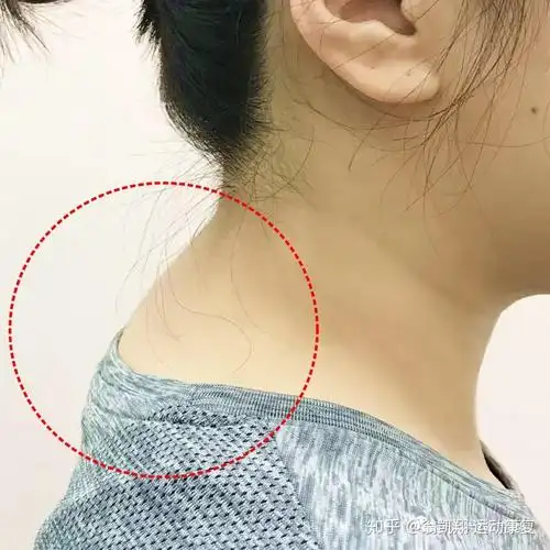 脖子后面鼓起来一个包应该就是颈椎突出