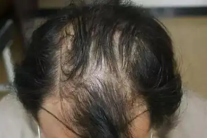 出现脱发的你小心成为地中海!