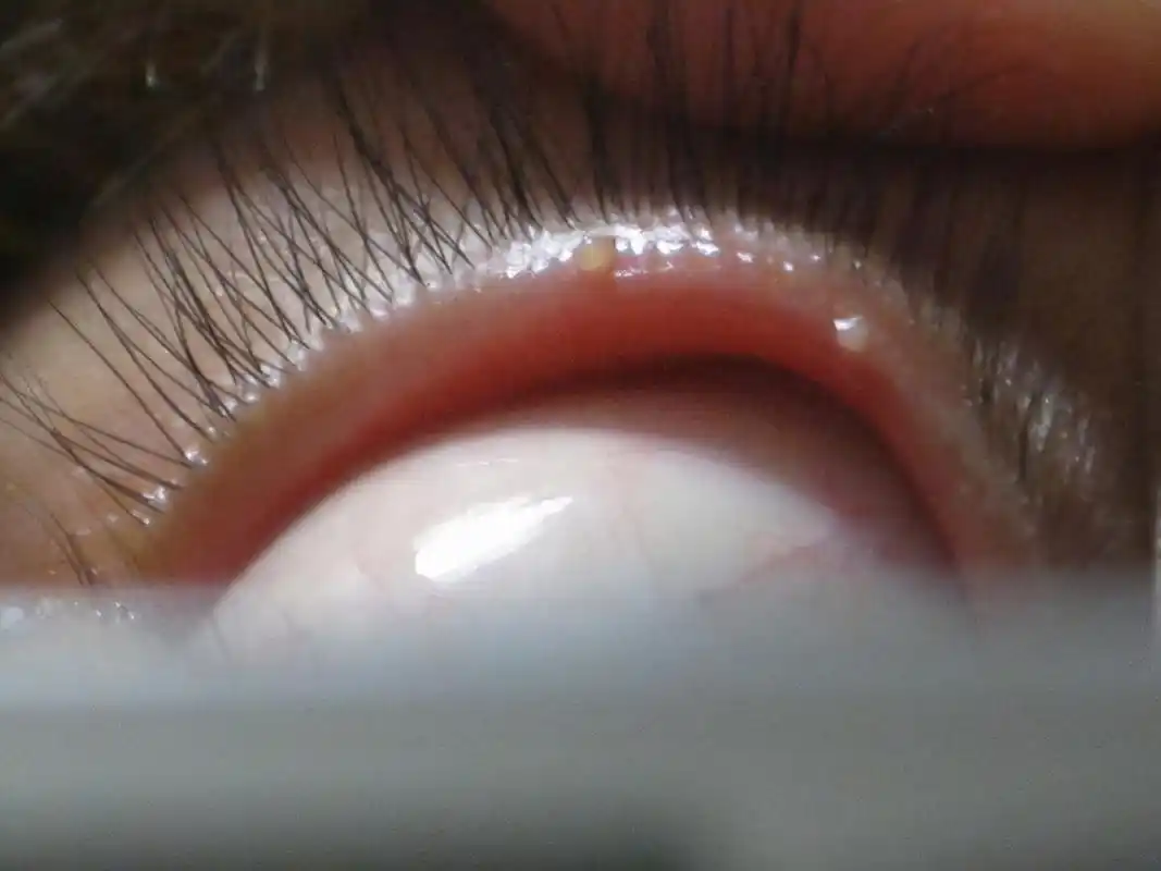 睑板腺癌是眼睑特有的恶性肿瘤,首选治疗方法是手术治疗