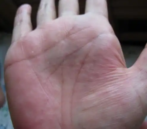 长沙皮肤病医院_引起手掌发痒的原因有哪些