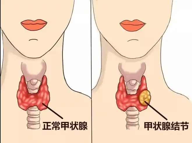 自身免疫甲状腺炎患者