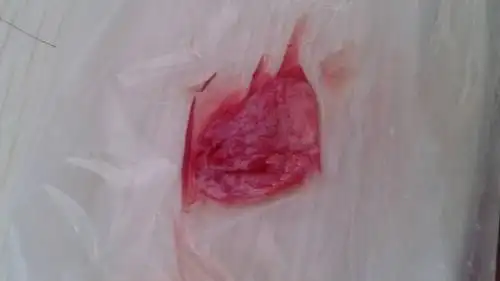 问:女朋友今天药流最后一天,吃药药三小时后排除孕囊,看孕囊是否完整?