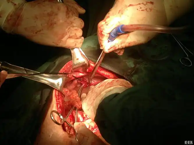 **分享**我手术时的图片 - 普外科讨论版 - 爱爱医医学论坛