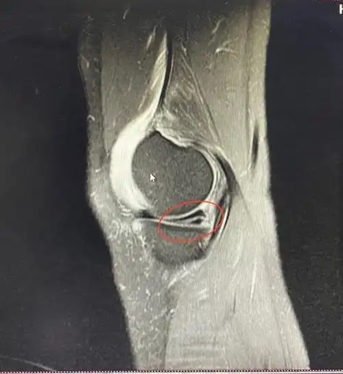 患者故事:今天来说说,膝关节韧带损伤那些事情
