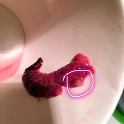 胚胎掉下来 移植后胚胎会流出来吗?-图片大观-奇异网