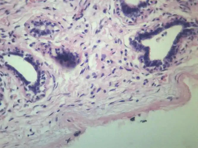乳腺纤维腺瘤显微切片图片第11张