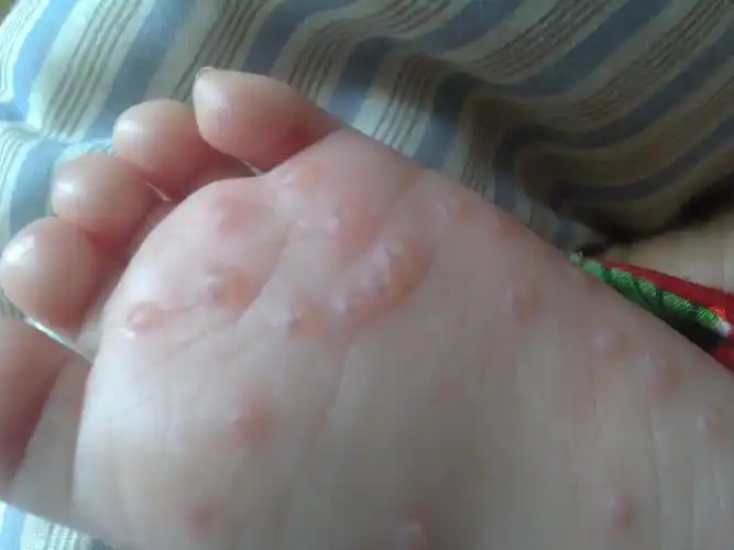 bgpfv    2015-07-12 16:23    浏览  33333  满意回答 这是出水痘呢