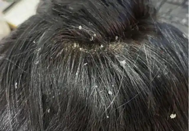 不妨看看我2个月的『除螨 抑菌』去头皮屑经历,解救自己.