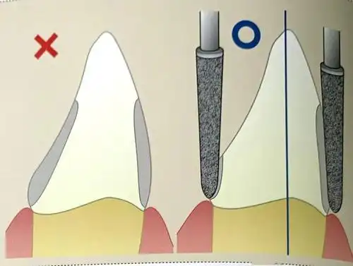 (精)前牙牙体预备要点及流程