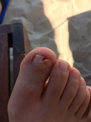 现在在沙滩上,脚趾甲碎了怎么处理,要剪掉吗?