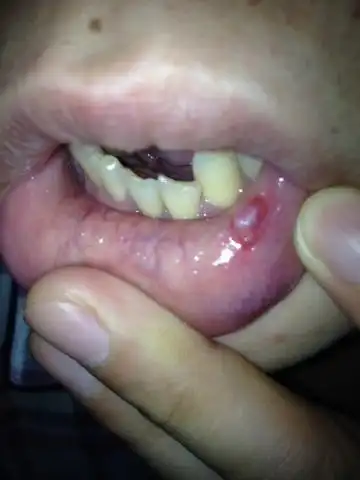 嘴唇内侧有个凸起肉包,嘴唇内长了一个肉疙瘩-图片大观-奇异网