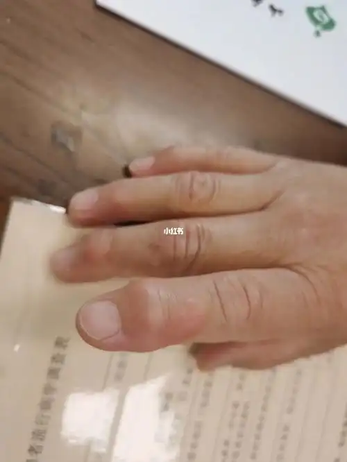 赫伯登结节可发生于骨性关节炎,即骨关节退行性变,是一种以关节软骨的