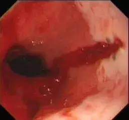 ④肝硬化导致的食管胃底静脉曲张破裂出血或者门脉高压性胃病:长期