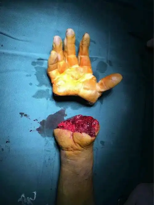 手术三年后的手掌离断患者恢复怎样了?