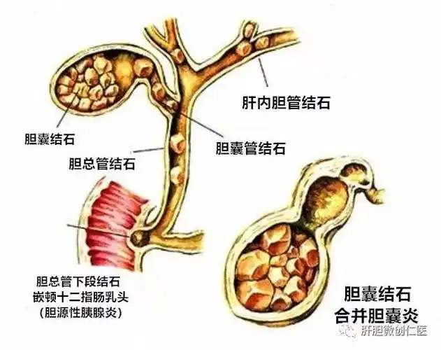 霉菌性阴炎好治疗吗_治疗霉菌性鬼头炎哪家医院好_胆囊炎怎么治疗最好