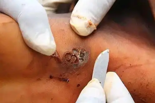 那些人体上的寄生虫能钻遍每一个洞