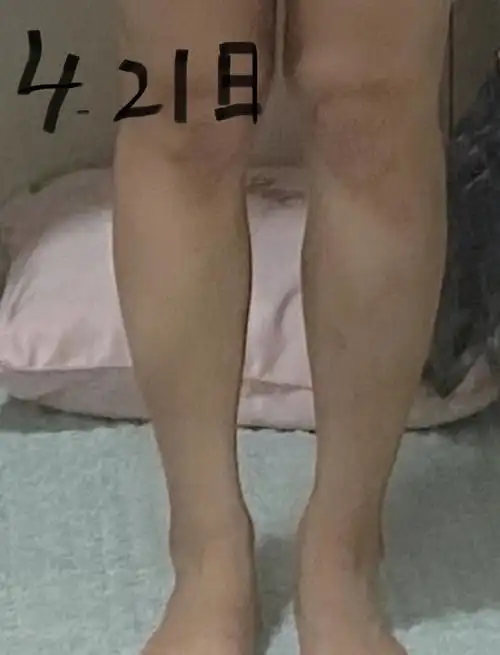 小腿外翻  #小腿粗壮  #小腿肌肉  #脂包肌小腿  #小腿肌肉内侧突出