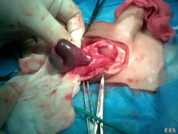 楼主langzizxx2011-03-31 21:39:03       14岁得小孩,阴囊疼了一天