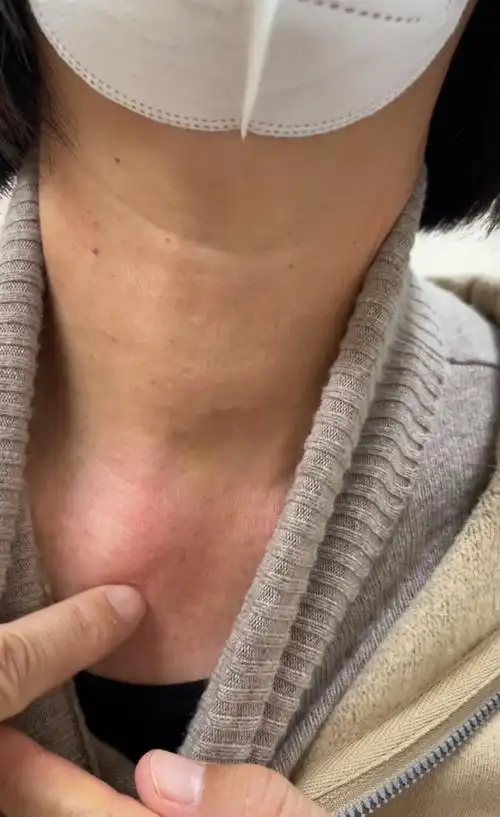 甲状腺癌_甲状腺癌治疗方式 - 好大夫在线