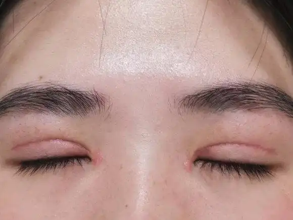 双眼皮术后第十四 伤口发红,疤痕增生 我还有救吗