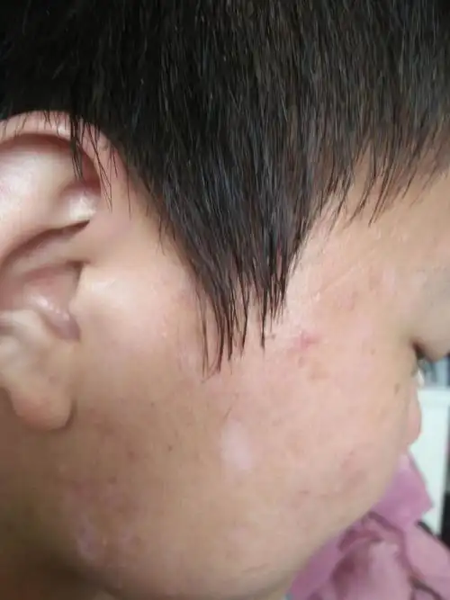 各位高手照片上脸上起的白斑是什么东西?咋么治?