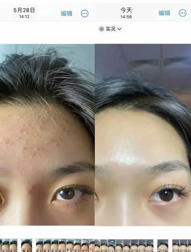 c)逆光疹(假闭口) 有明显的颗粒感,又叫白头粉刺,能挤出油 - 抖音