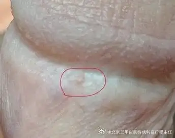 男,28岁,高主任您好,上周五晚上洗澡发现冠状沟长了一个小疙瘩,不痛