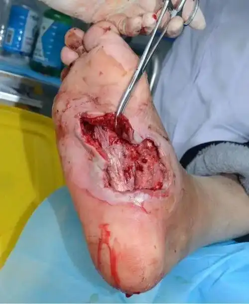 中医祛腐生肌河南糖尿病足患者不截肢痊愈