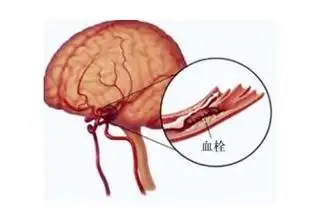 最有效的治疗急性脑梗死的方法---静脉溶栓或动脉溶栓和取 - 好大夫