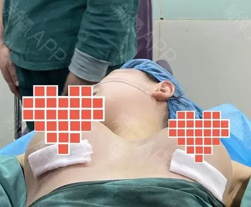 北京假体隆胸好不好_效果图_氧气2u0ab假体隆胸术后第0天_新氧美容