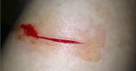 不小心被美工刀划出这样一道伤口,伤口几乎