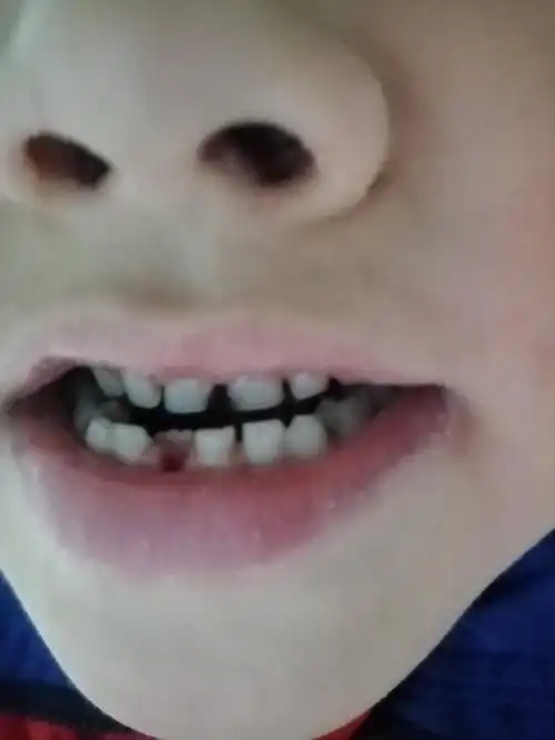 儿子第一次掉牙!